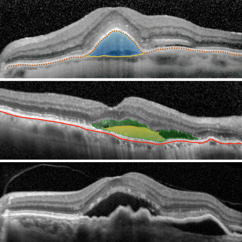 Tomografia OCT, Tomografía de Coherencia Optica