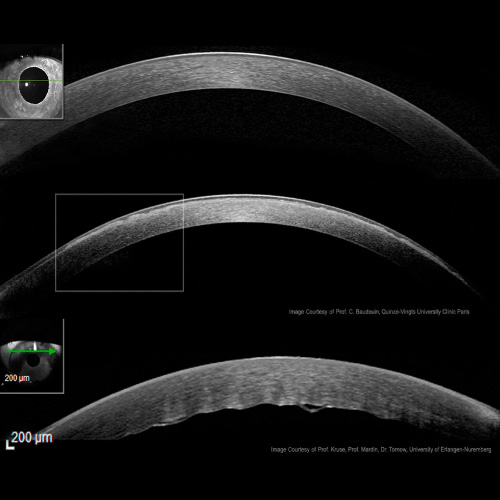 Tomografia OCT, Tomografía de Coherencia Optica