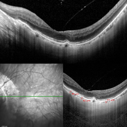 Tomografia OCT, Tomografía de Coherencia Optica