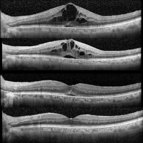 Tomografia OCT, Tomografía de Coherencia Optica
