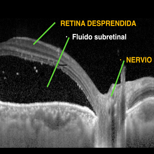 Tomografia OCT, Tomografía de Coherencia Optica