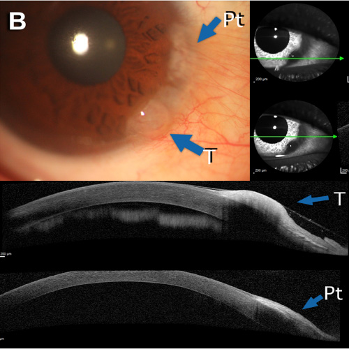 Tomografia OCT, Tomografía de Coherencia Optica