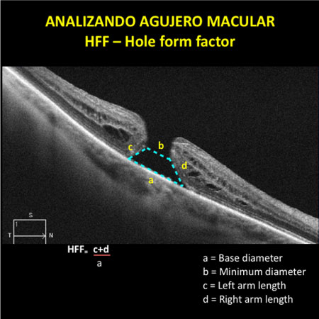 Tomografia OCT, Tomografía de Coherencia Optica