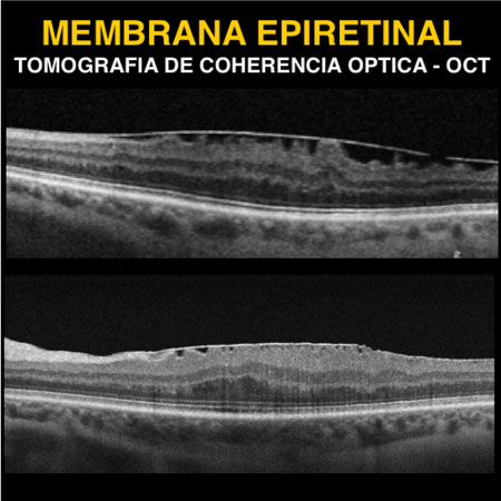 Tomografia OCT, Tomografía de Coherencia Optica