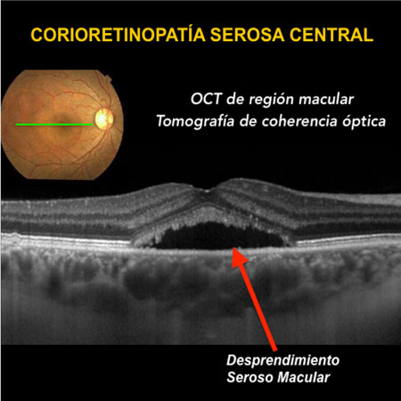 Tomografia OCT, Tomografía de Coherencia Optica